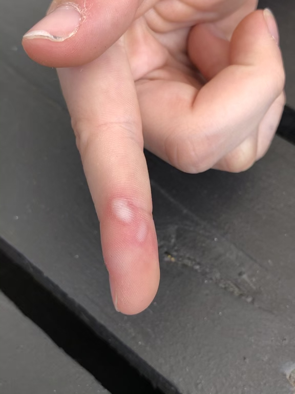 Blisters on finger from soldering iron burn